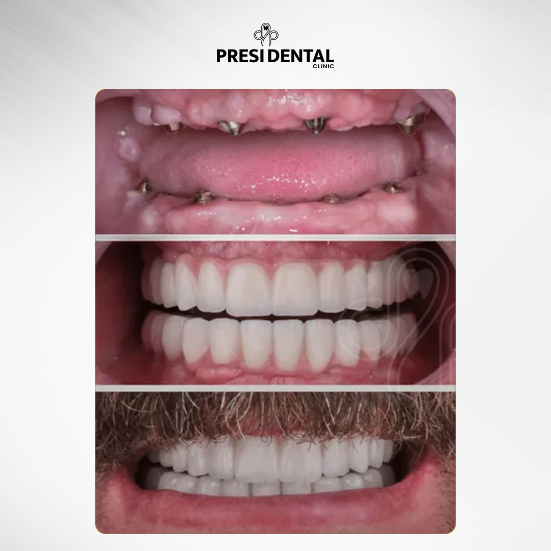 B&A 3